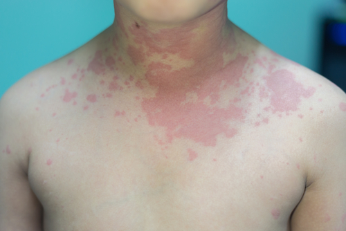 allergic_reactions