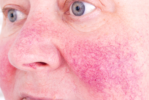 rosacea