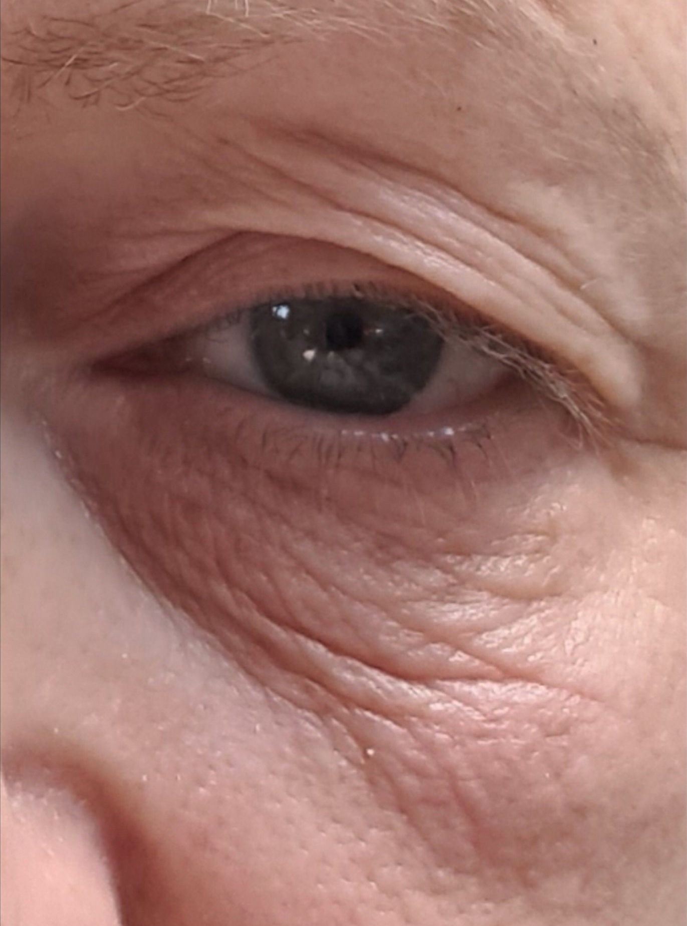 eye-before