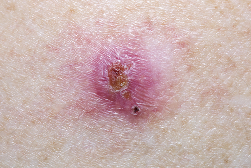 basal_cell_carcinoma