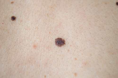 melanoma